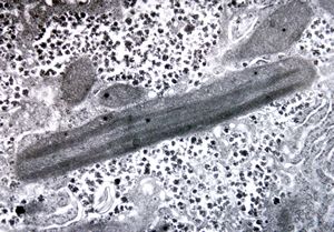 M,11y. | megamitochondria - Wilson disease M,11y. | megamitochondria - Wilson disease